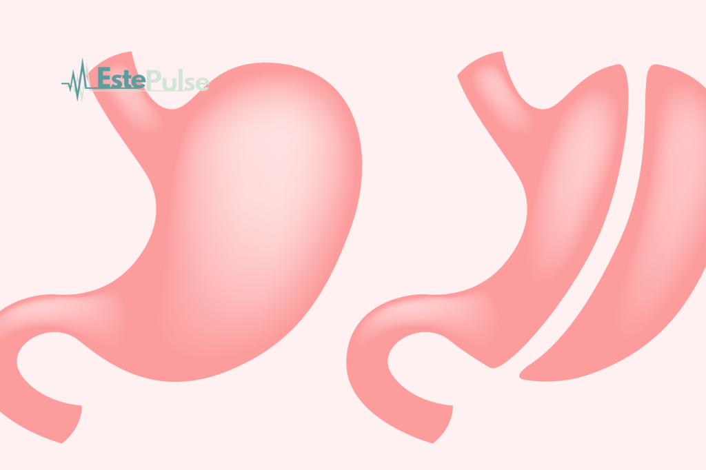 Gastric sleeve in turkey