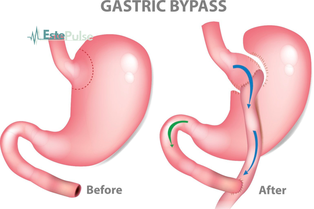 gastric bypass in turkey