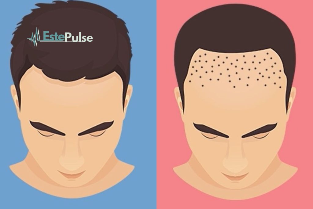 hair transplant techniques in turkey