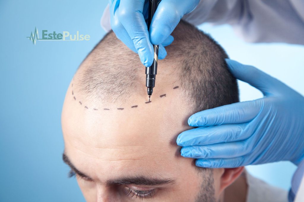 FUE hair transplant in turkey