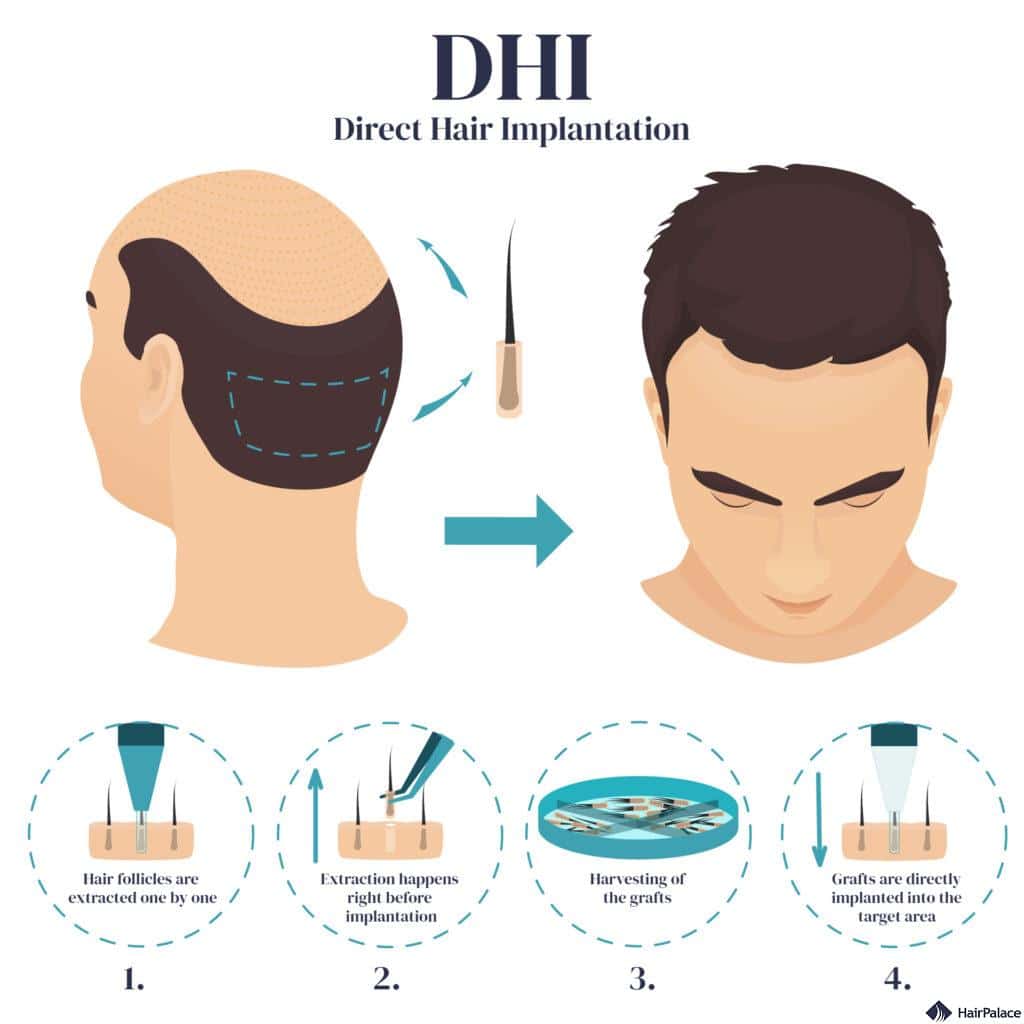 dhi hair transplant turkey