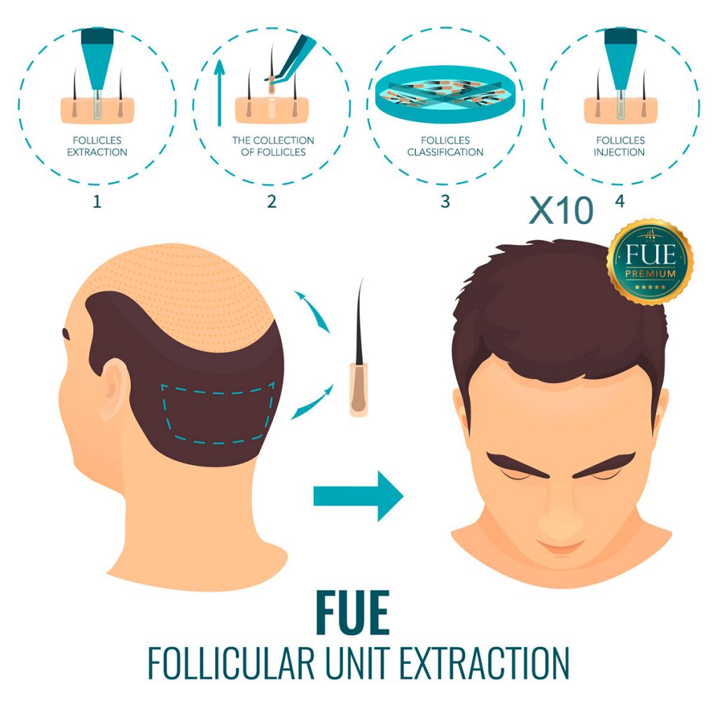 fue hair transplant turkey